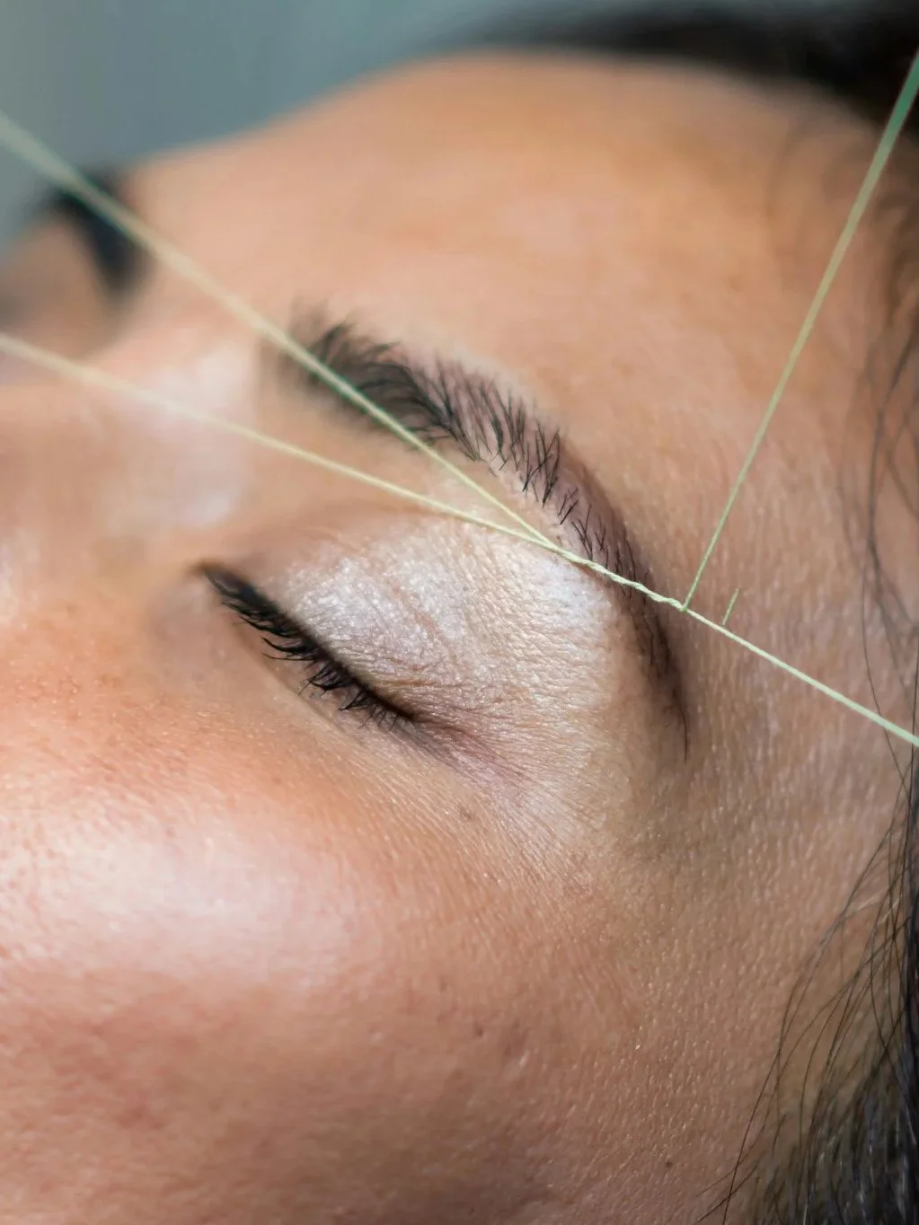 Close-up of a person's closed eye during acupuncture treatment, with acupuncture needles inserted near the eyelid.