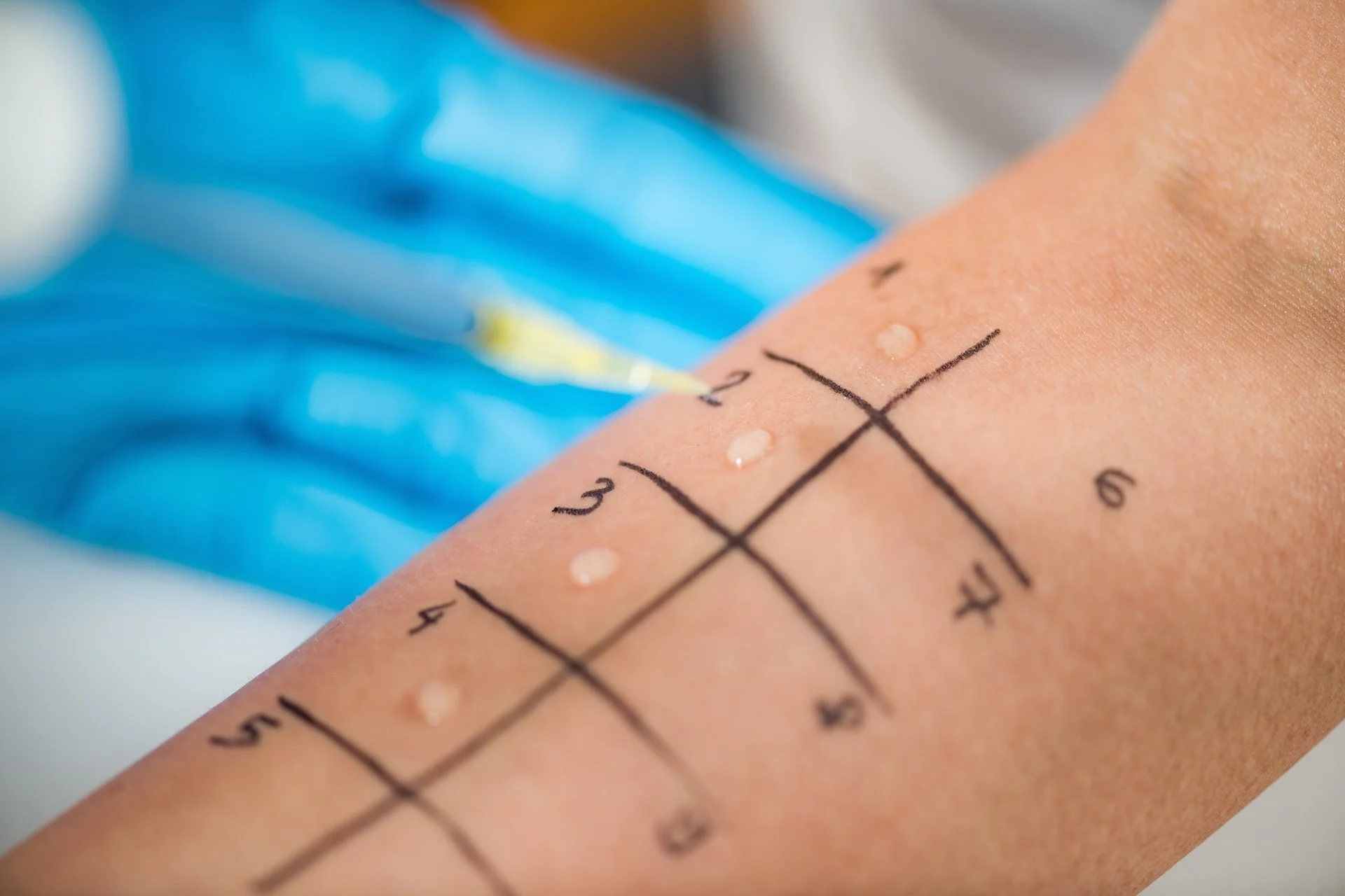 Close-up of a person's arm during a blood draw with a needle and tube, marked with measurement markings and small dots of blood.