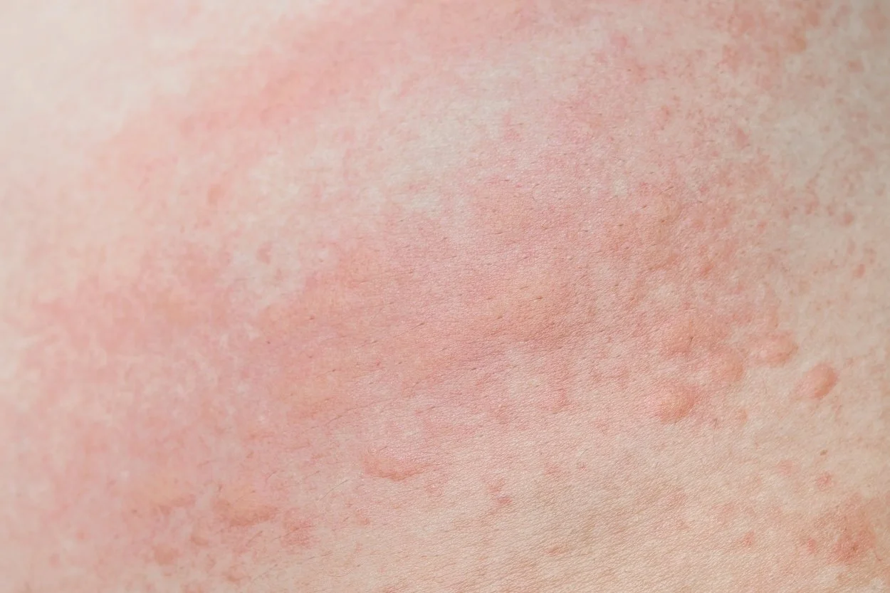 Close-up of skin with redness and skin irritation.