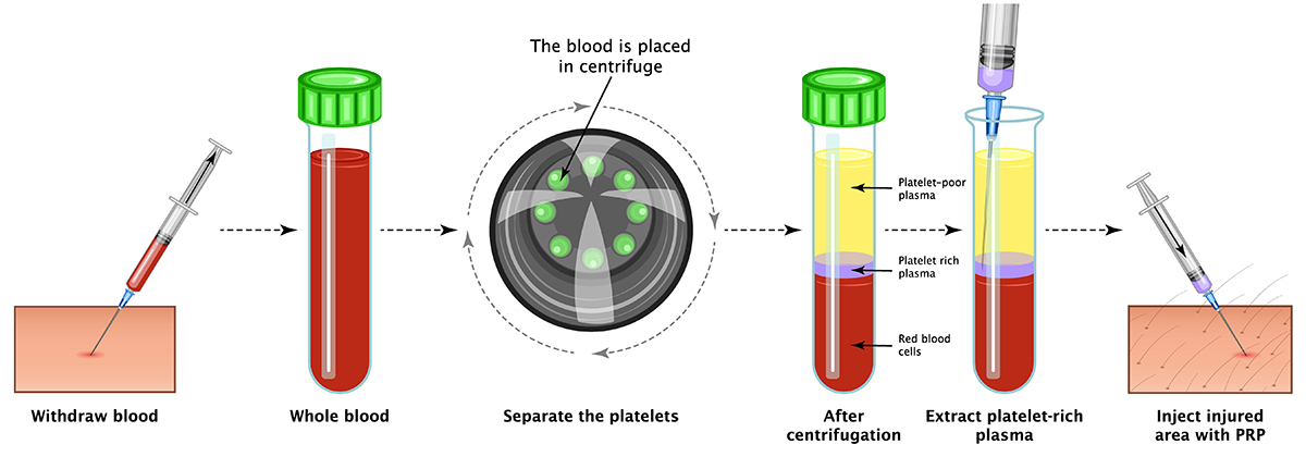 Diagram showing the process of preparing platelet-rich plasma (PRP) from blood. Steps include withdrawing blood, centrifuging to separate components, extracting platelet-rich plasma, and injecting the PRP into an injured area.