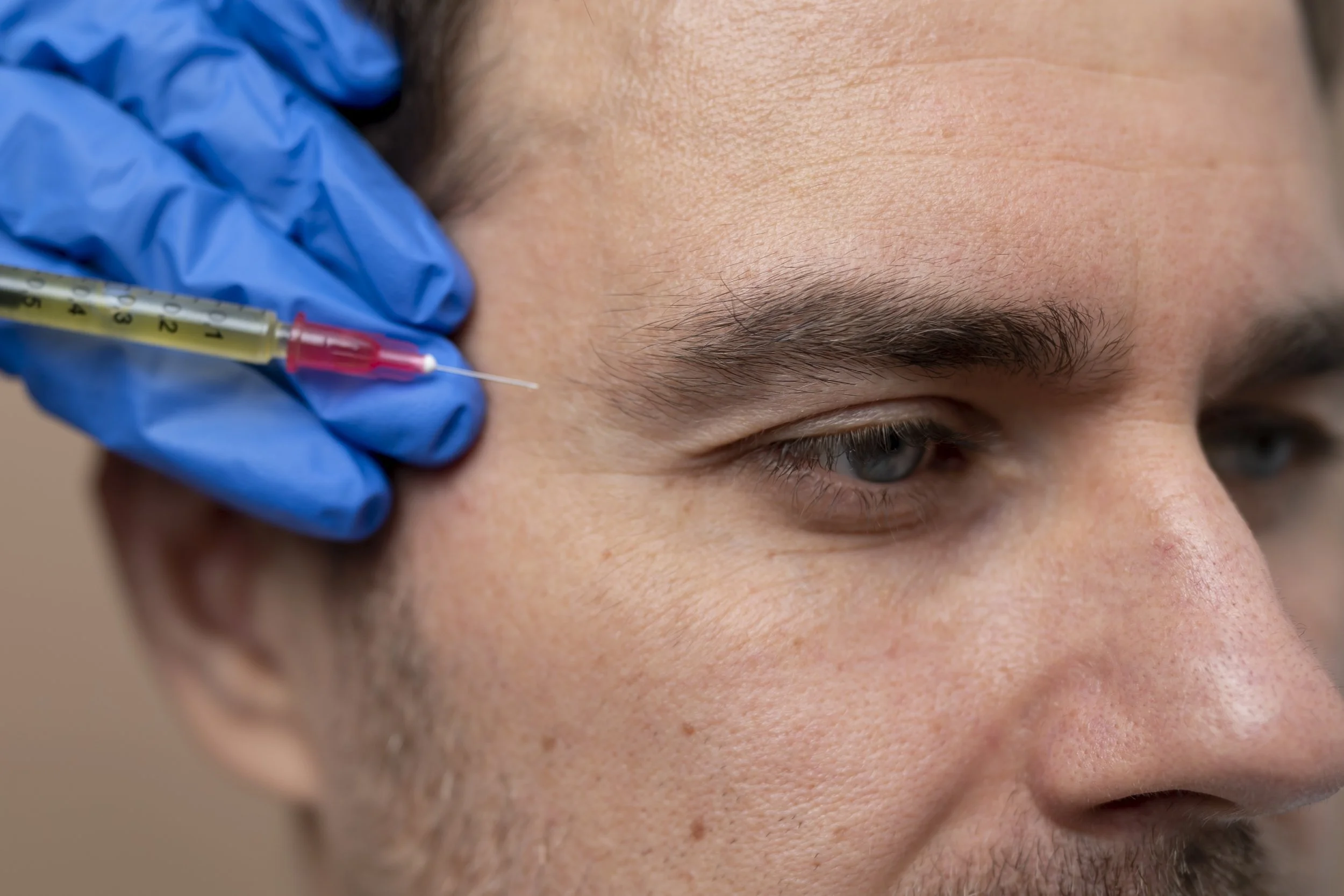Close-up of a person receiving an injection in the temple area with a syringe and a healthcare worker wearing blue gloves.