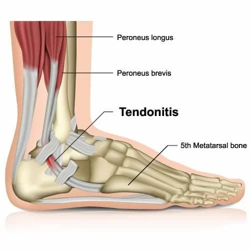 Anatomical illustration of a human foot and ankle showing tendons, the fifth metatarsal bone, and muscles including peroneus longus and brevis, with labels highlighting these parts.