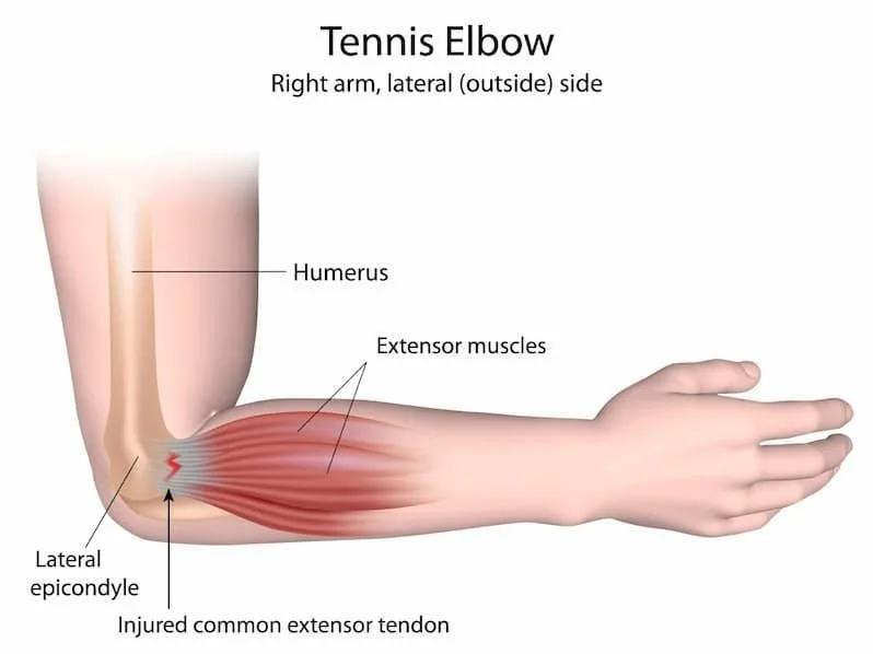 Diagram of a right arm showing a tennis elbow injury, highlighting the humerus, lateral epicondyle, injured common extensor tendon, paralyzed extensor muscles, on the outside of the arm.