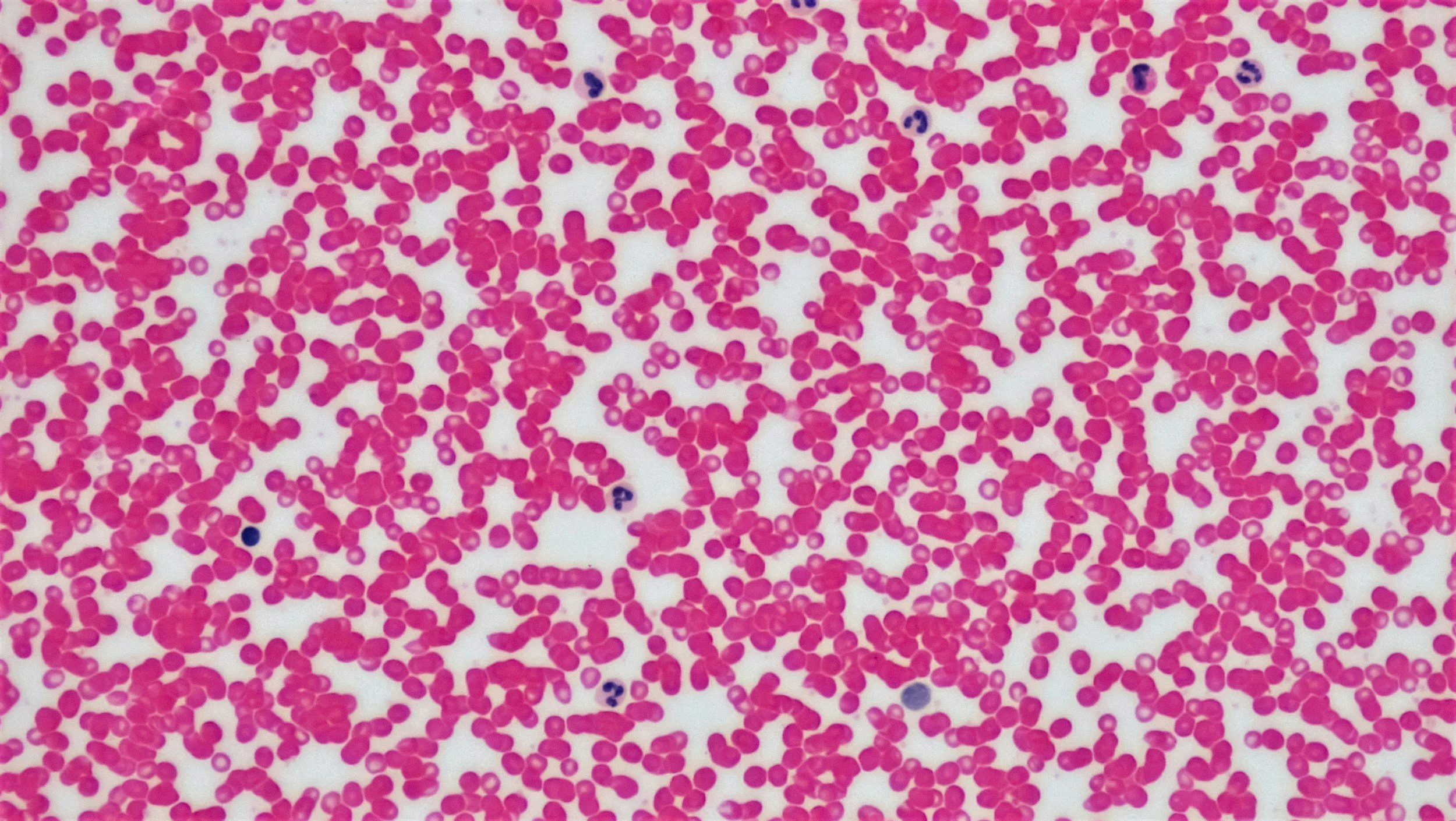 Microscopic view of numerous small, round, pink-red blood cells on a white background with a few darker cells scattered throughout.