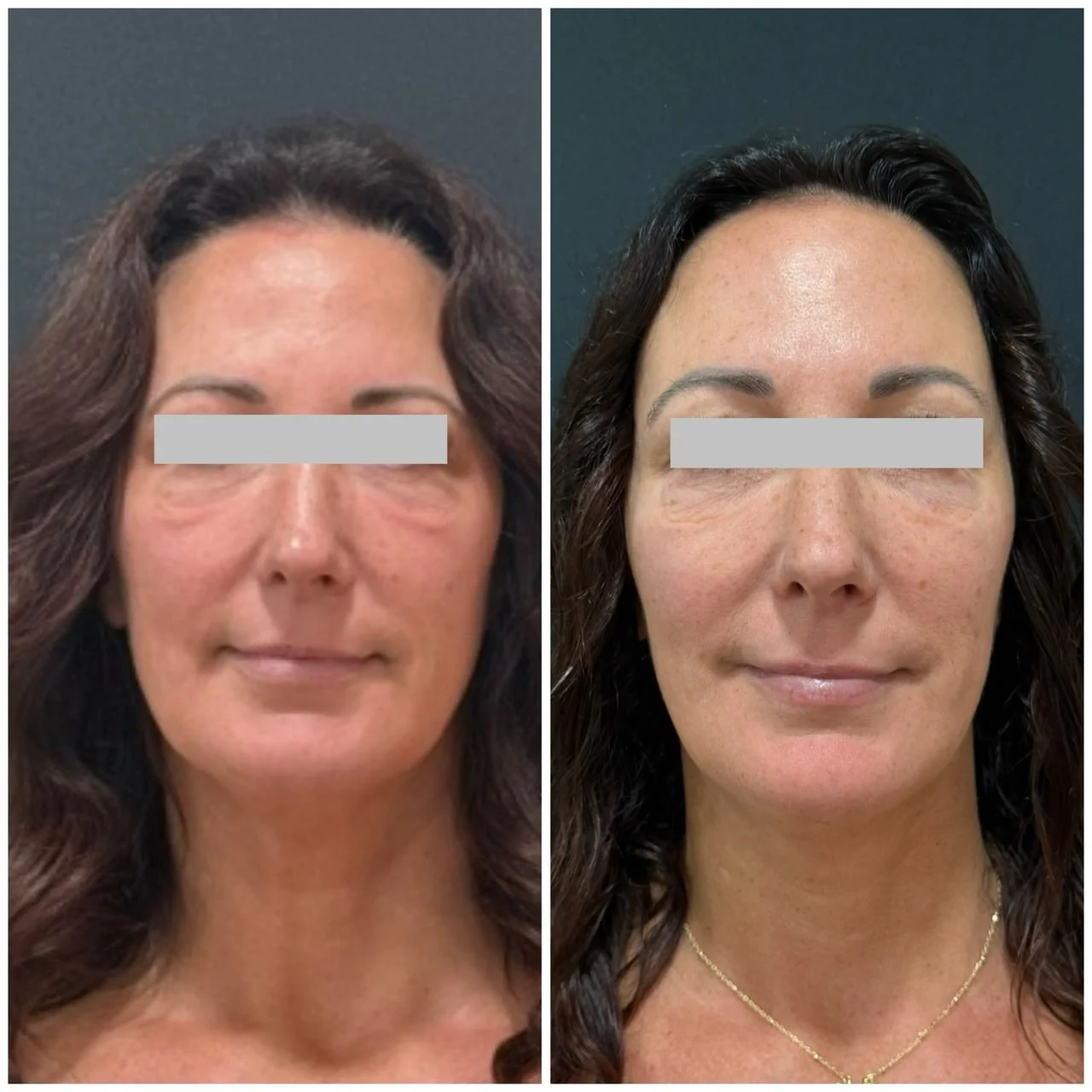 Side-by-side comparison of a woman's face before and after cosmetic treatment, showing reduced wrinkles and improved skin texture.