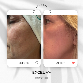 Comparison of a person's cheek showing reduction in wrinkles and smoother skin in the 'after' image, labeled 'before' and 'after' with a note on transformation, promoting a skincare or cosmetic treatment.