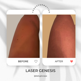 Close-up of a person's skin showing a before and after comparison of skin treatment, with the 'before' image having blemishes and the 'after' image showing clearer skin.