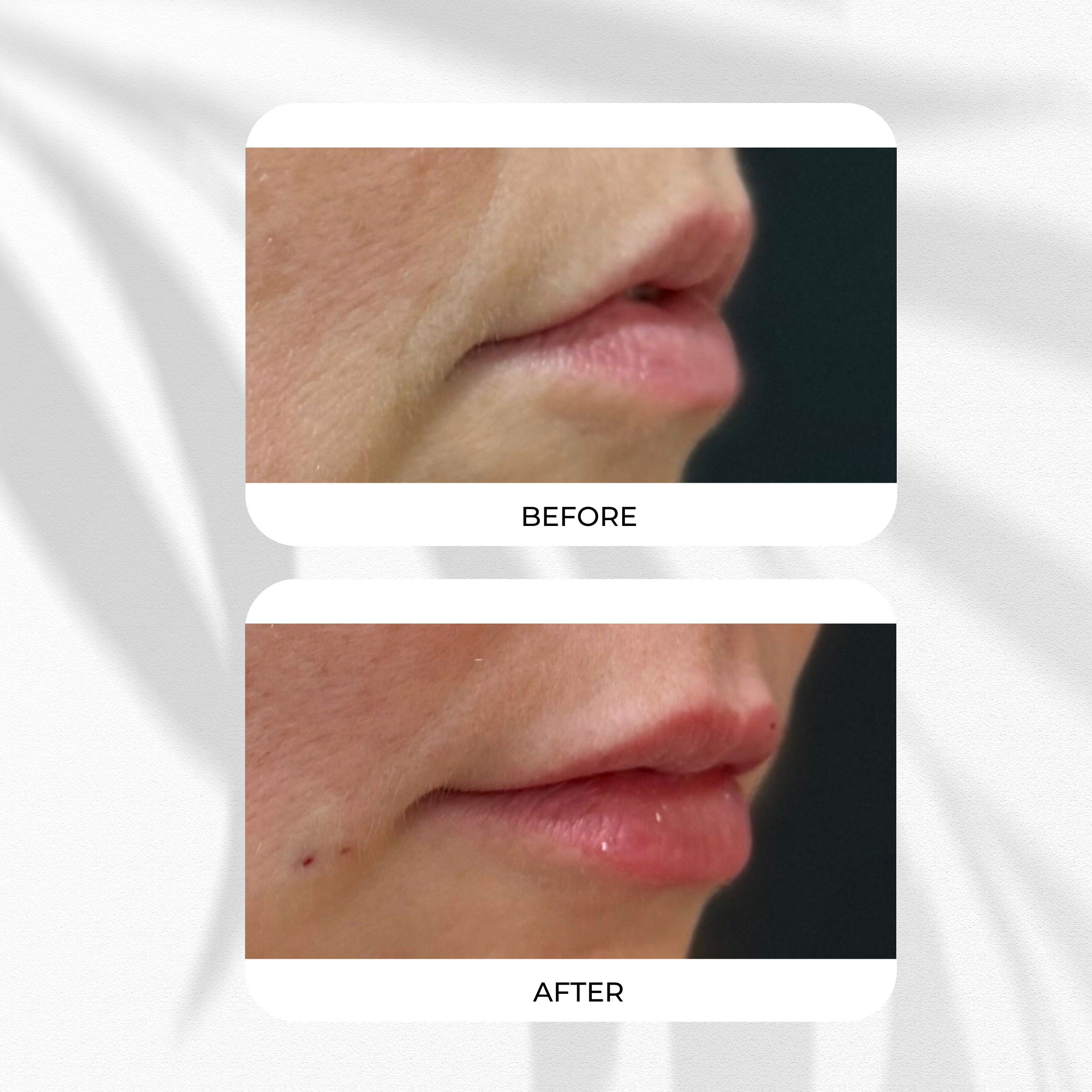 Close-up of a person's lips and nose showing before and after images of lip enhancement or cosmetic procedure. The 'before' image shows natural lips, while the 'after' image shows fuller, more defined lips with slight swelling.
