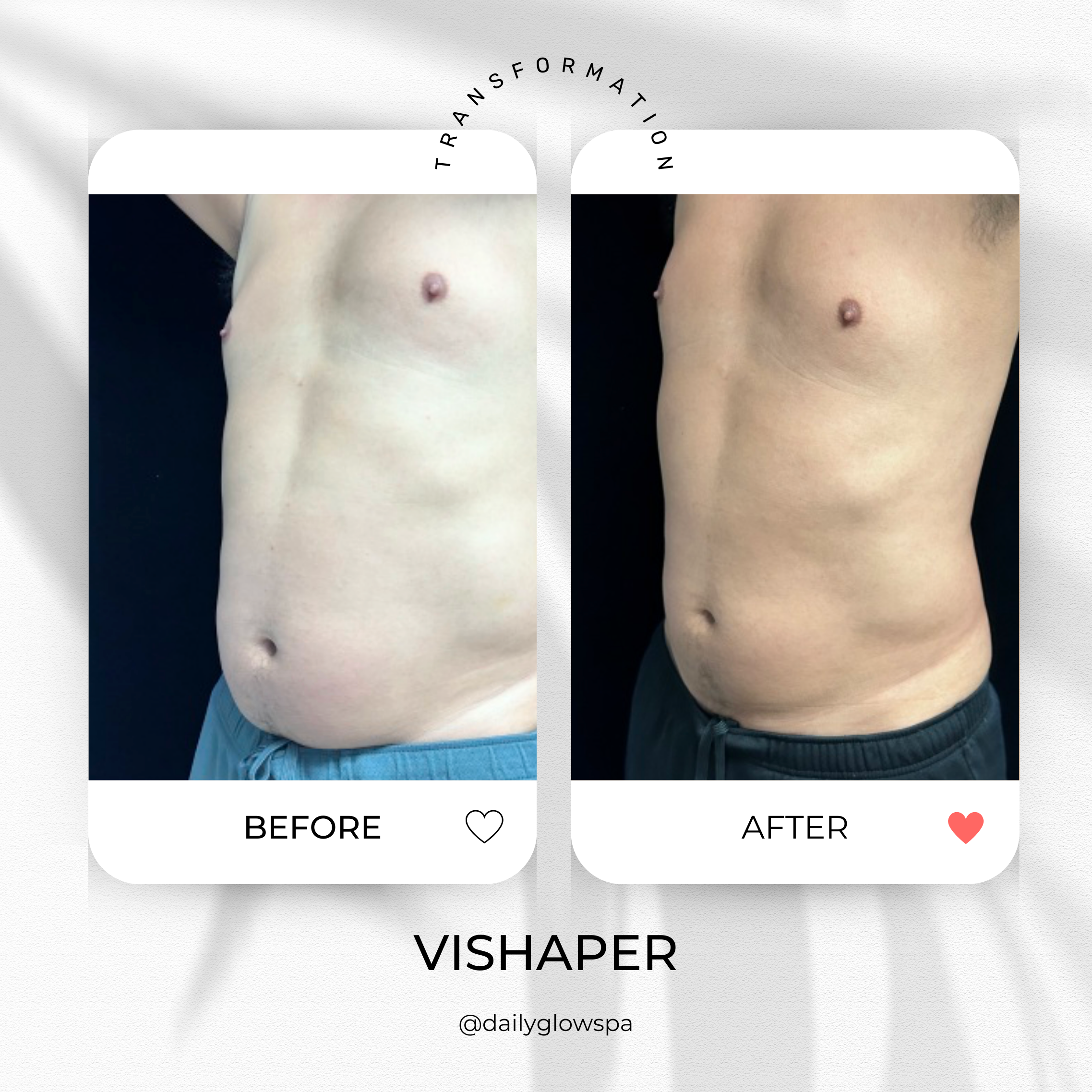 Comparison of a man's abdominal area before and after using VISHAPER, showing reduction in stomach size and improved muscle tone.