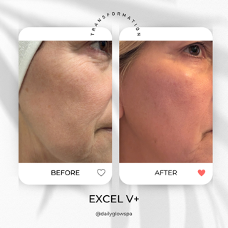 Side-by-side comparison of a woman's skin showing improvement in texture and appearance after treatment, labeled 'Before' and 'After'.