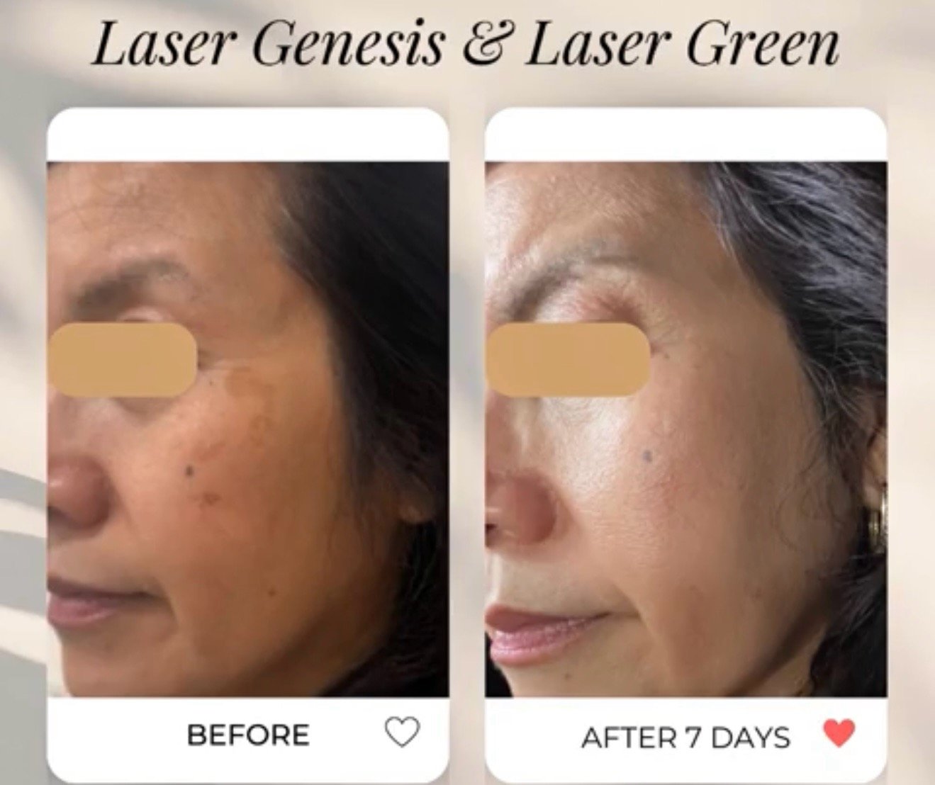 Comparison of a woman's skin before and after 7 days of laser treatment, showing clearer, smoother skin on the right side.