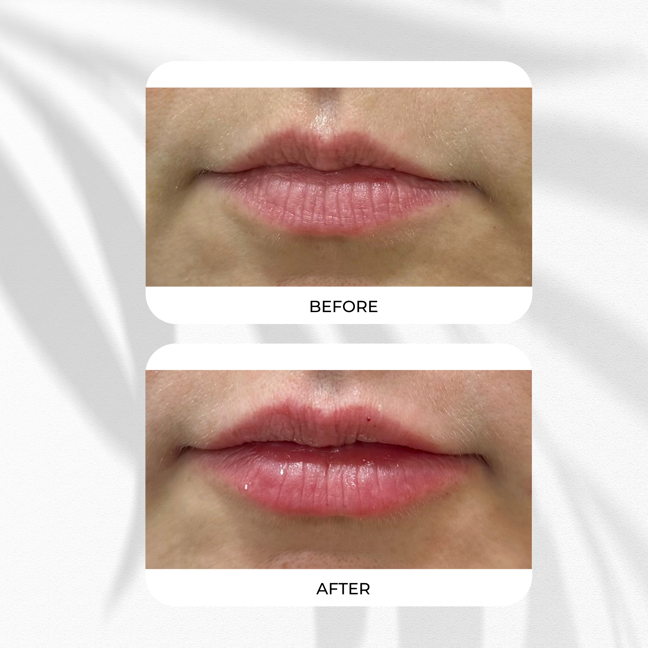 Close-up of lips before and after a cosmetic procedure showing improved lip fullness and hydration in the after image.