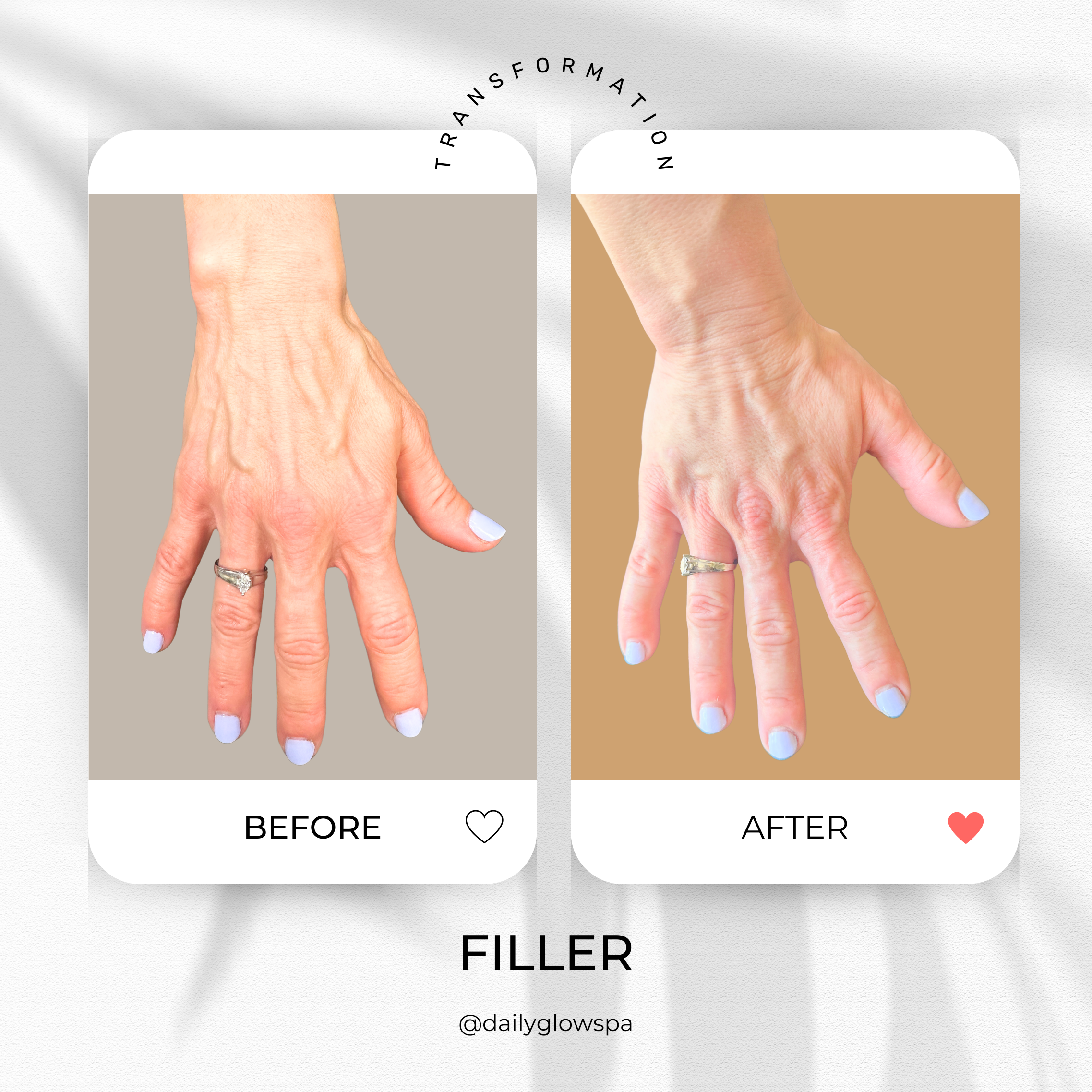 Comparison of a hand before and after a filler treatment. The 'before' hand shows visible veins and thinning skin, while the 'after' hand appears more plump with smoother skin.