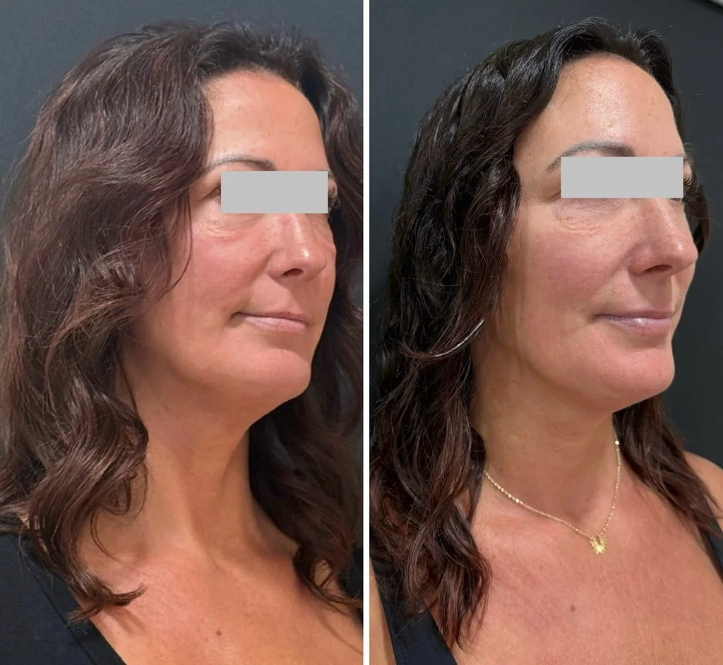 A side-by-side comparison of a woman before and after a cosmetic or skincare treatment, showing improvements like smooth skin and a more youthful appearance.