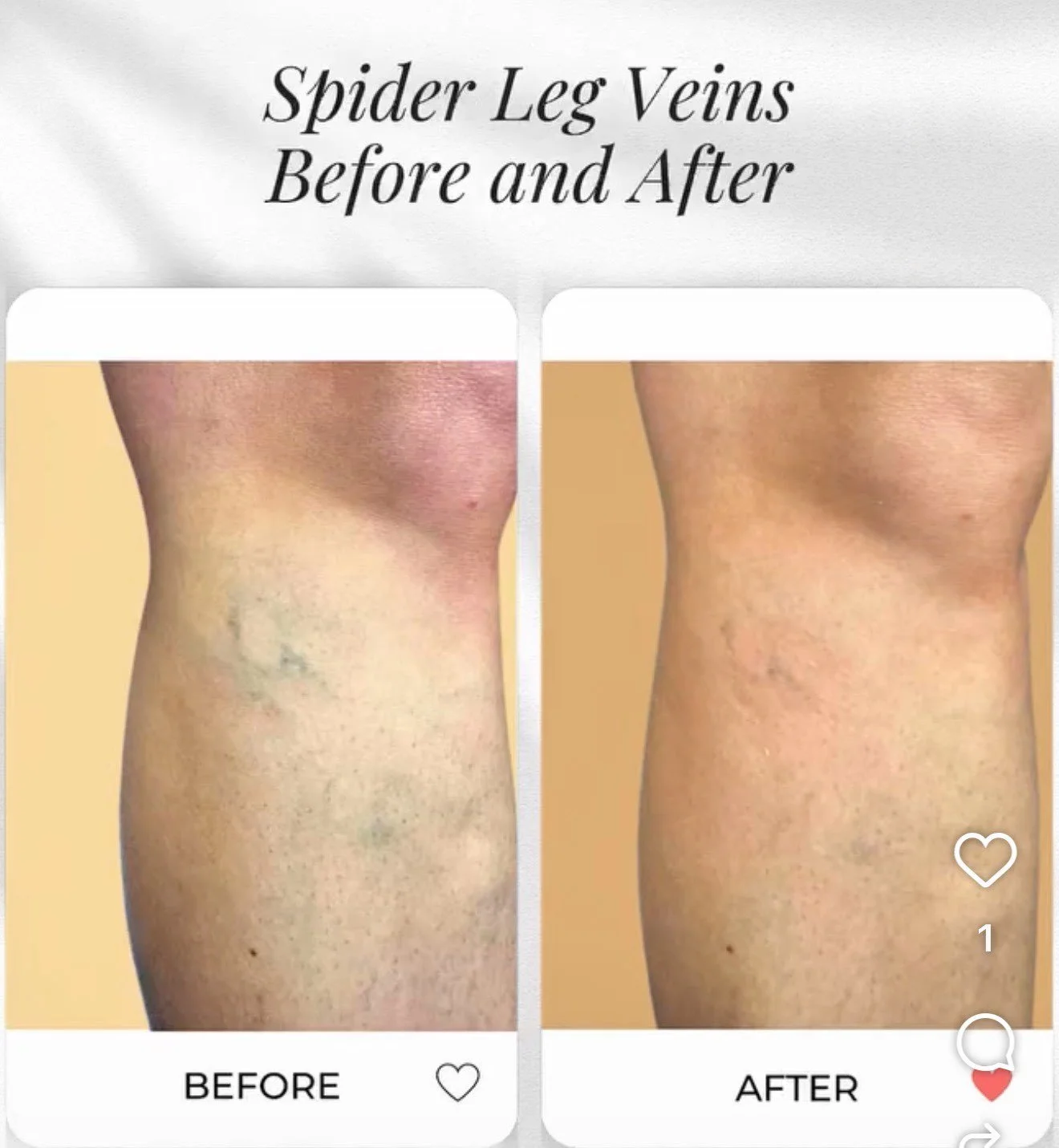 Comparison of a person's leg and thigh area showing spider vein reduction before and after treatment.