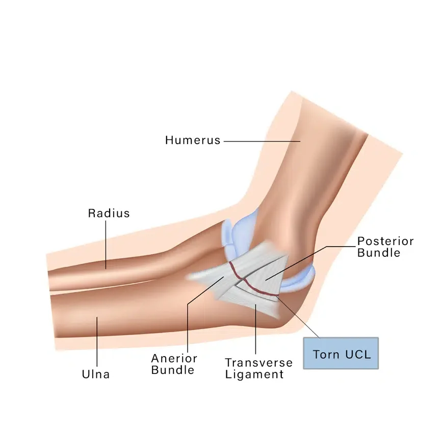 Non-Operative Management of UCL Injuries