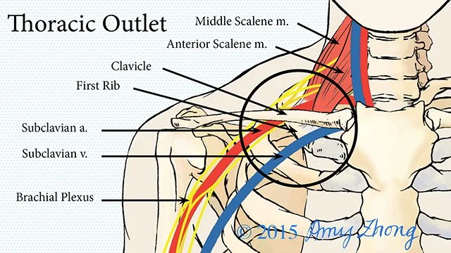 What is Thoracic Outlet Syndrome (TOS)