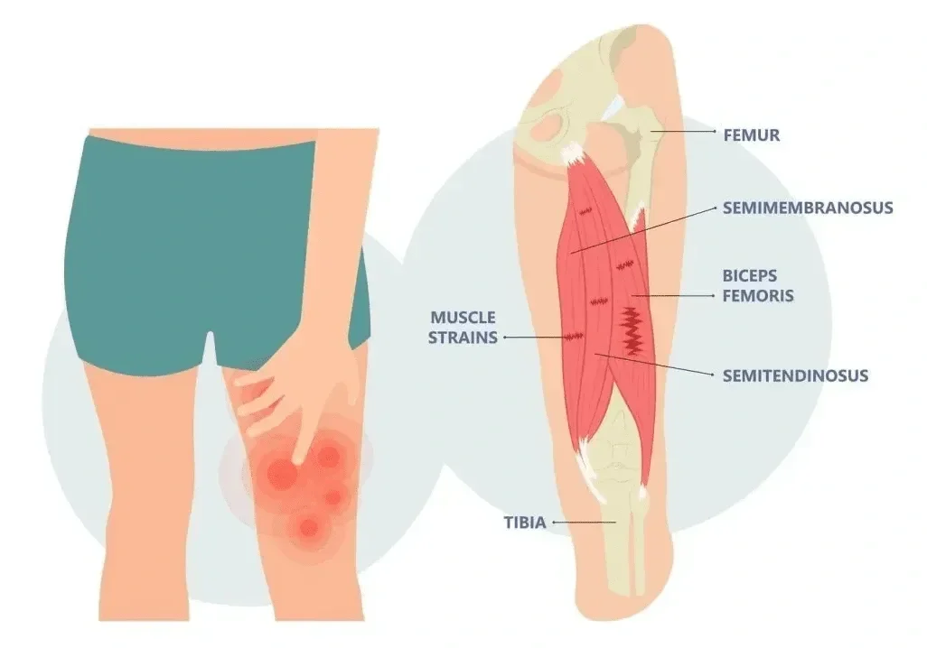 Hamstring Strains: Nip Them in the Butt