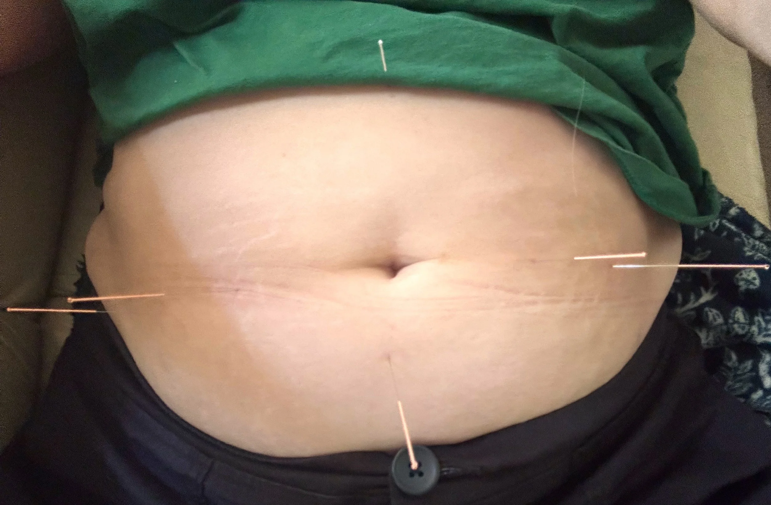 willow tree acupuncture digestion.JPG