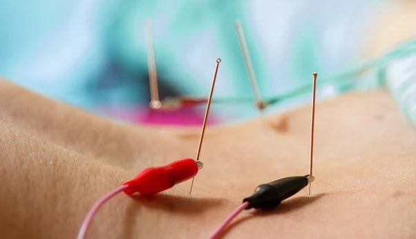 willow tree electro acupuncture stomach.jpg