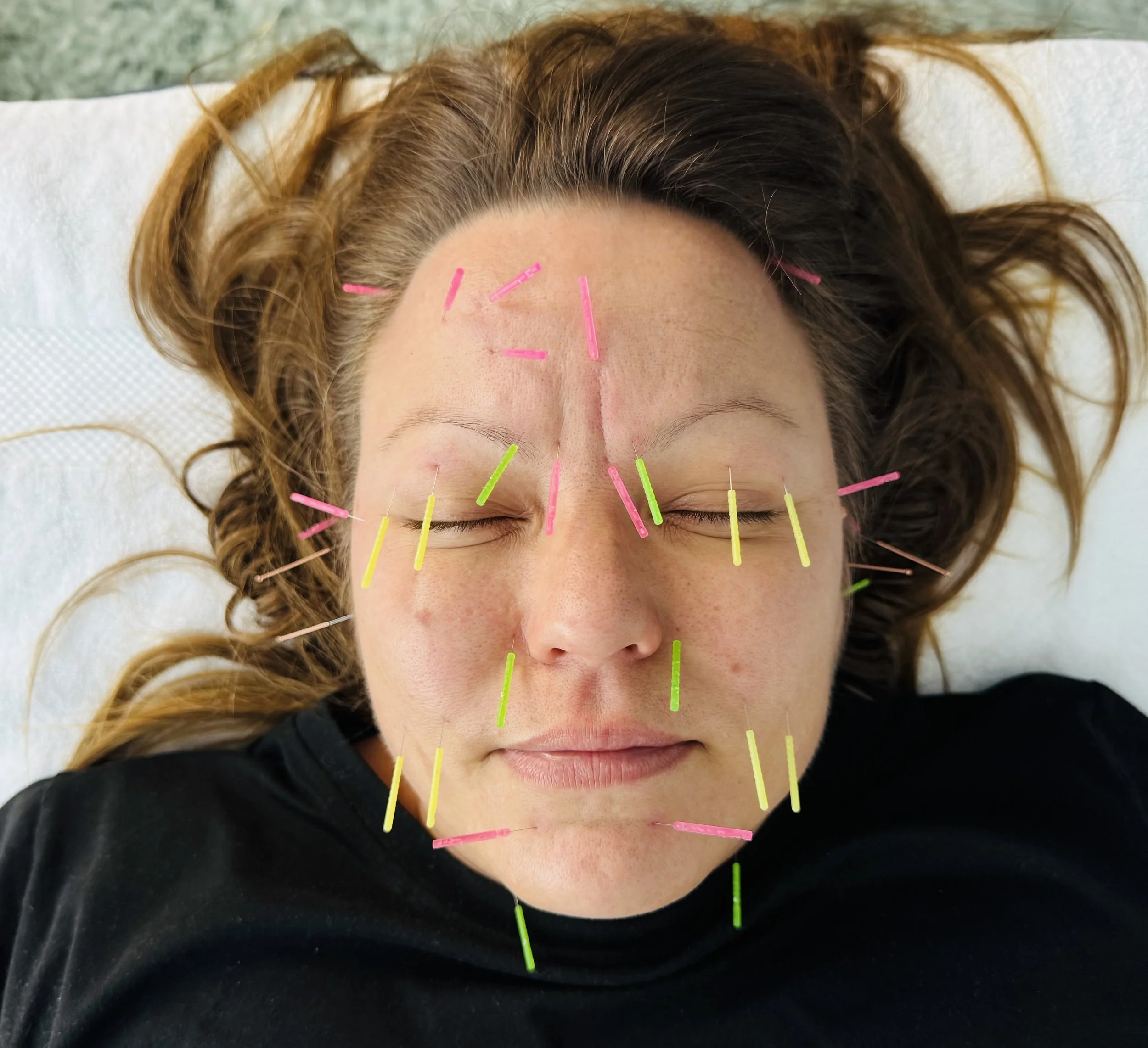 Willow Tree Acupuncture Cosmetic Facial Acupuncture