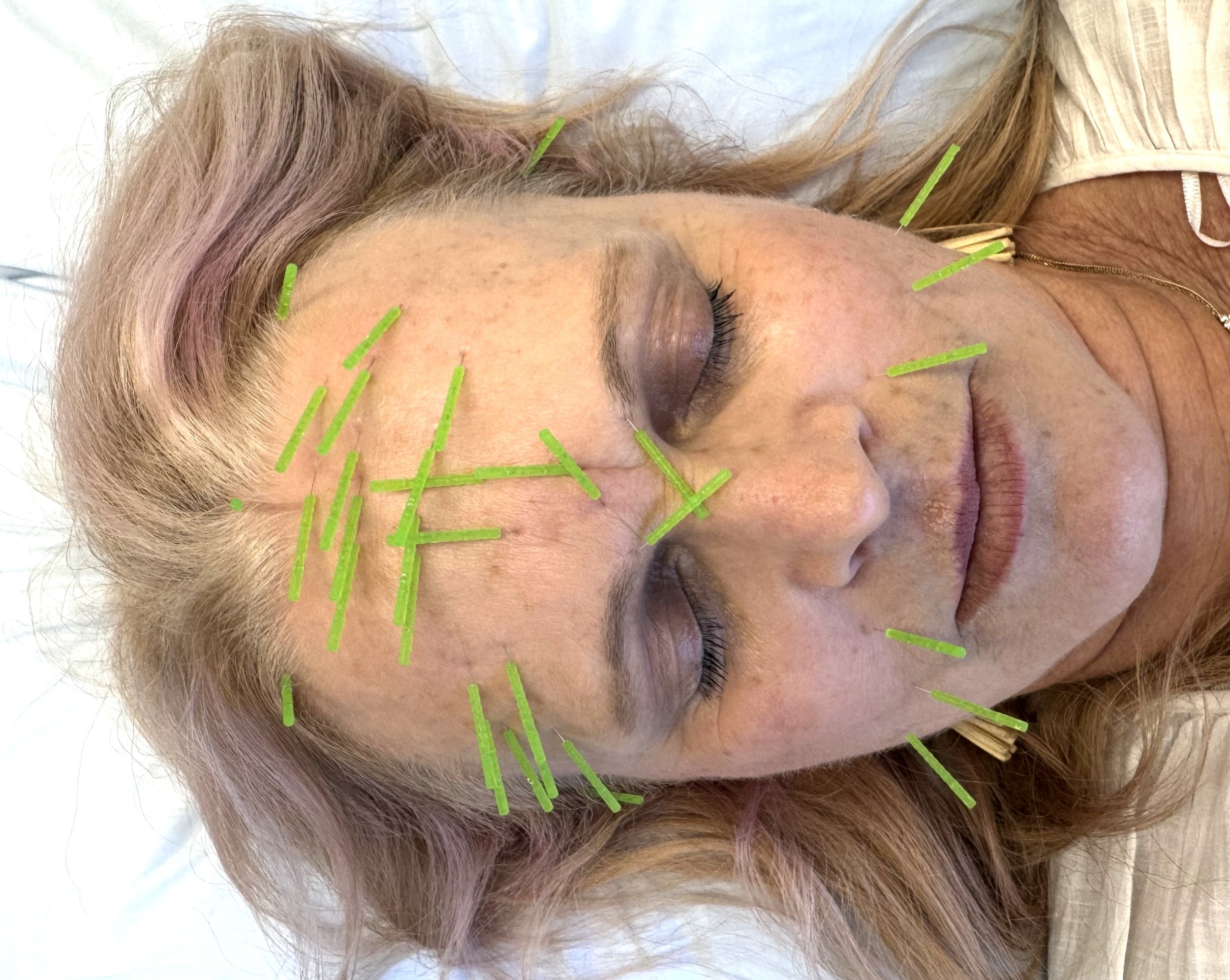 willow tree acupuncture cosmetic renae.JPG