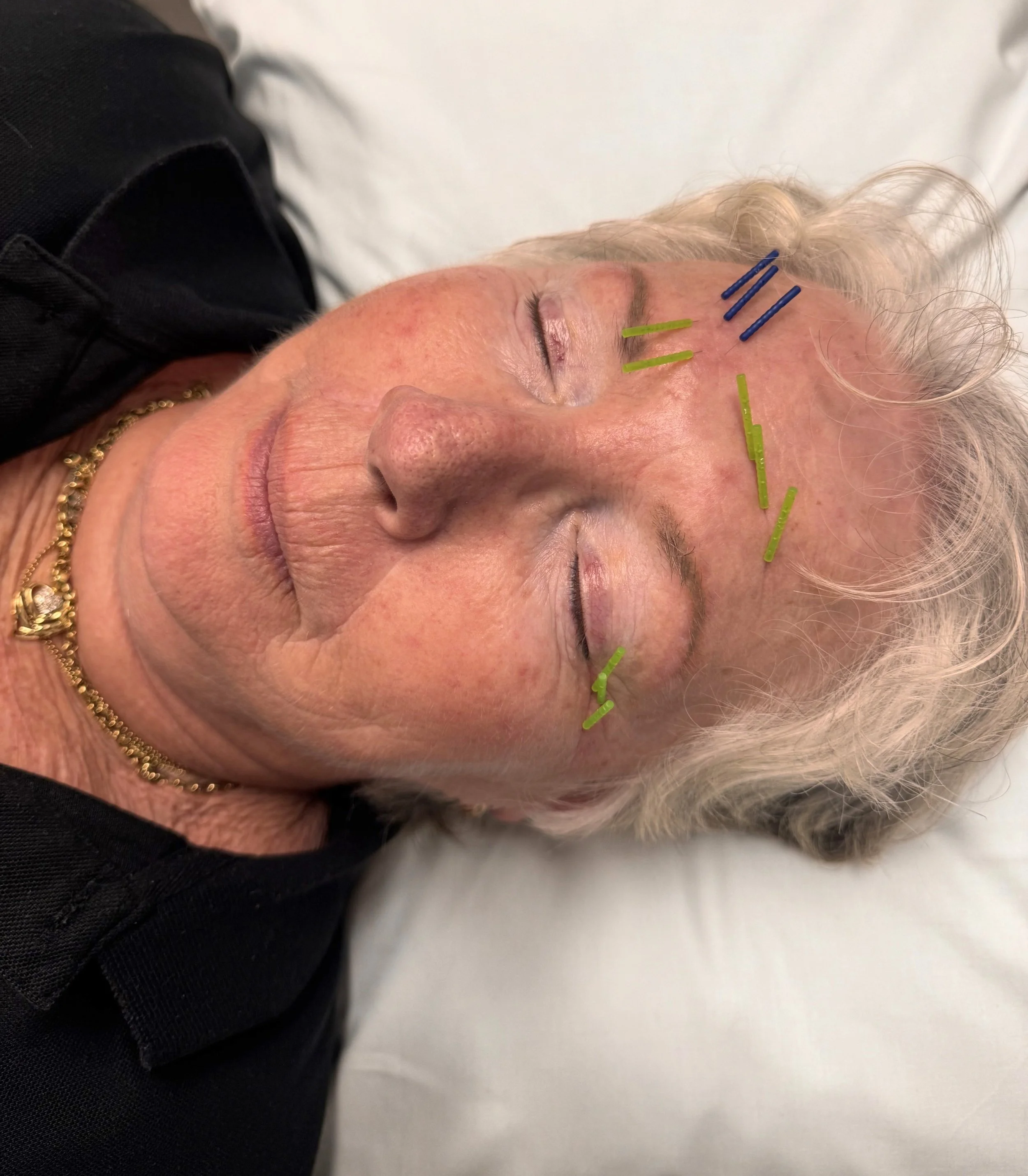 willow tree acupuncture facial acupuncture scars.JPG