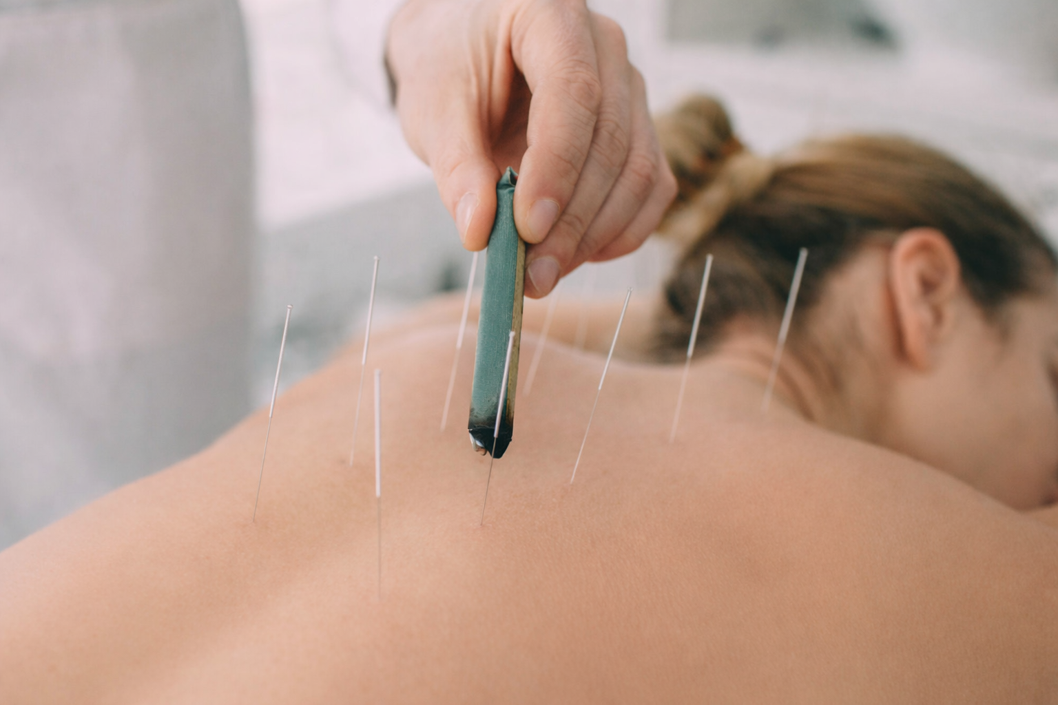 Willow tree acupuncture patient with needles and moxa.png