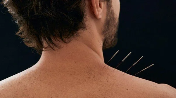 willow tree acupuncture young male shoulder.jpg