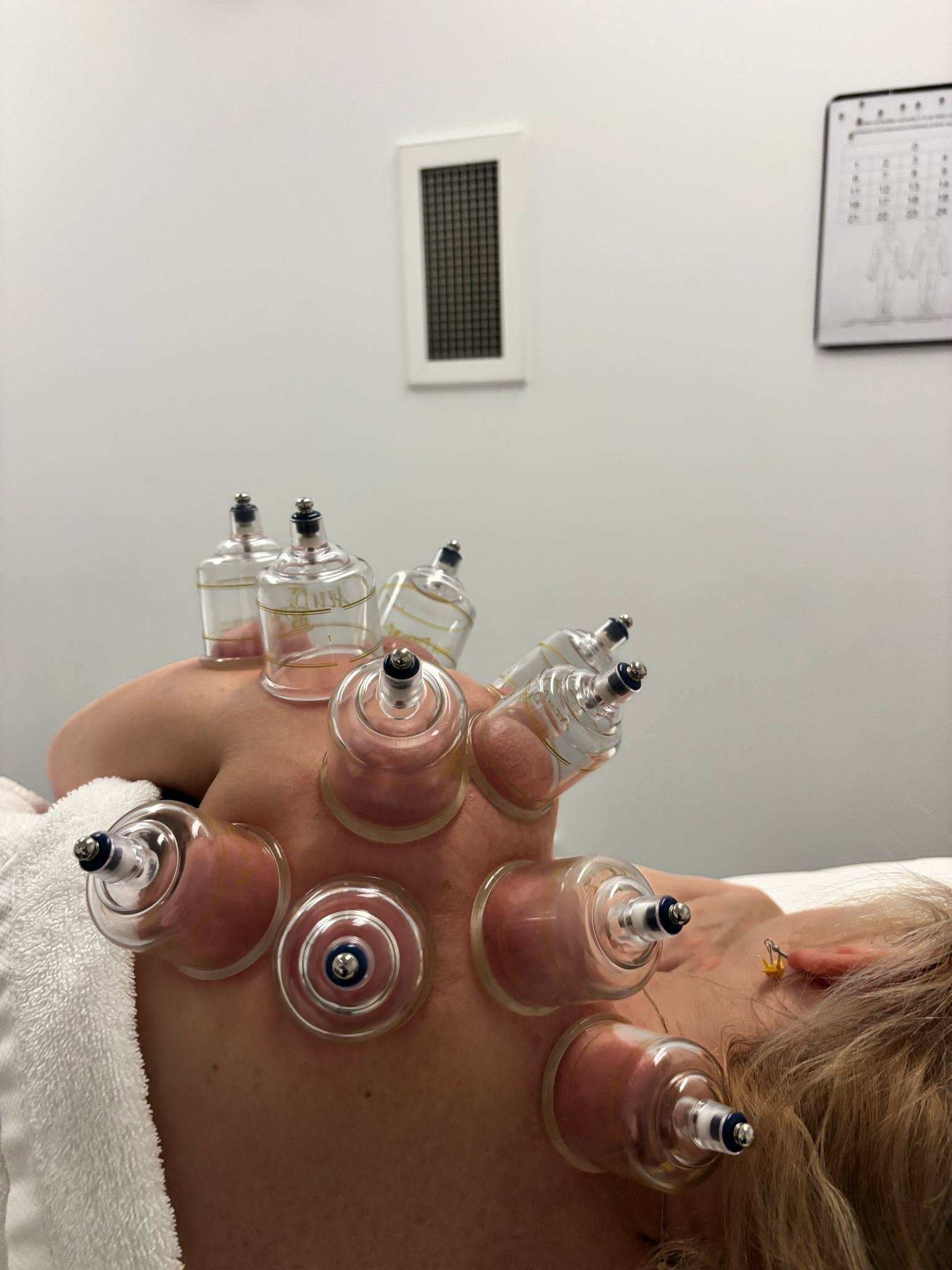 Willow Tree Acupuncture shoulder cupping.jpeg