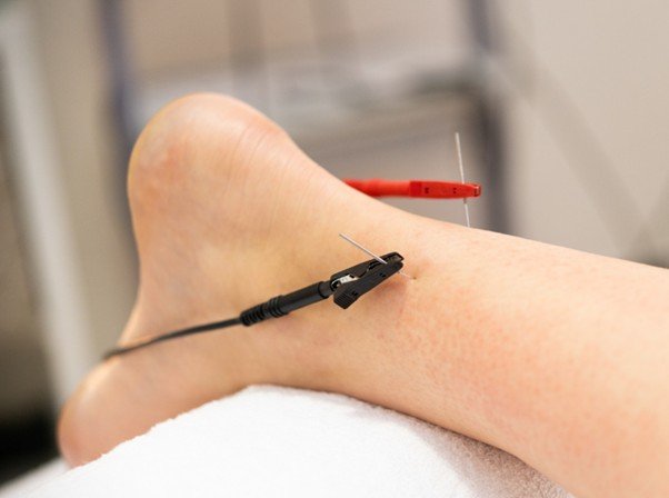 willow tree acupuncture electro heel.jpg