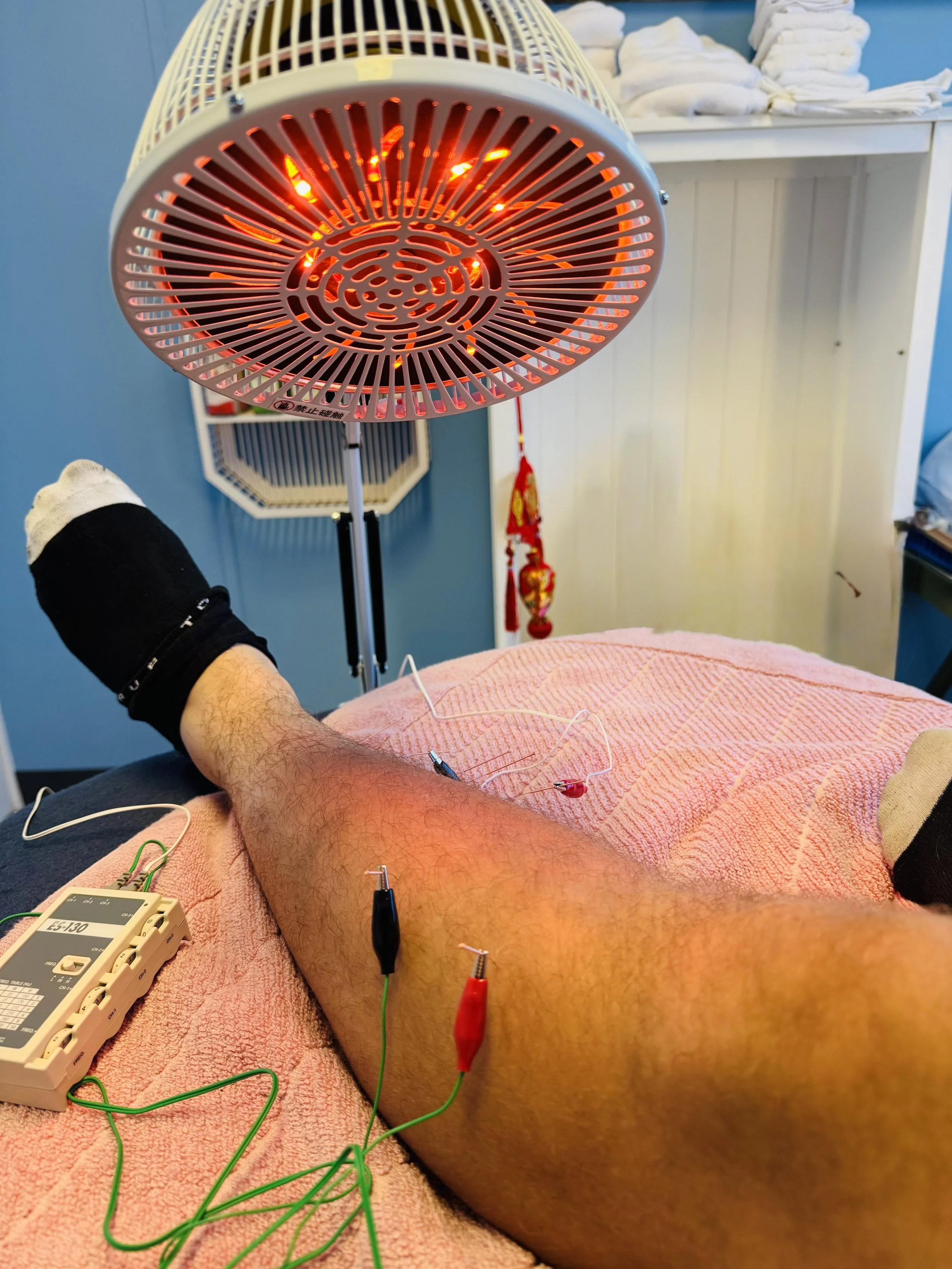 electro acupuncture on shin splints