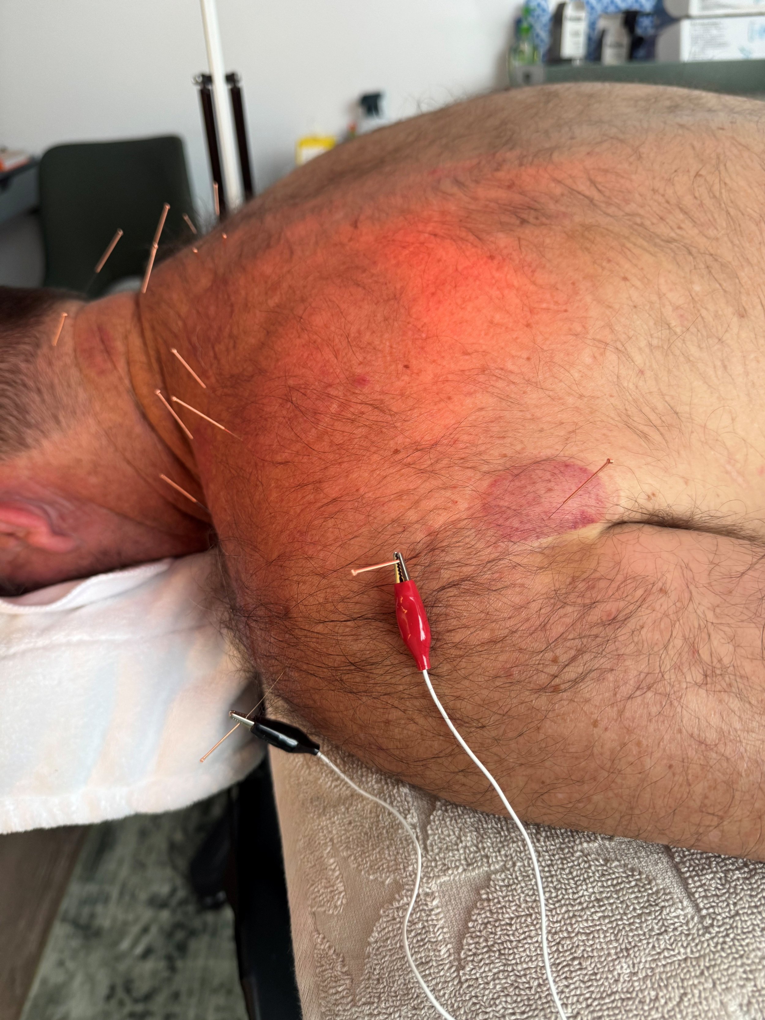 electro acupuncture on the shoulder rotator cuff