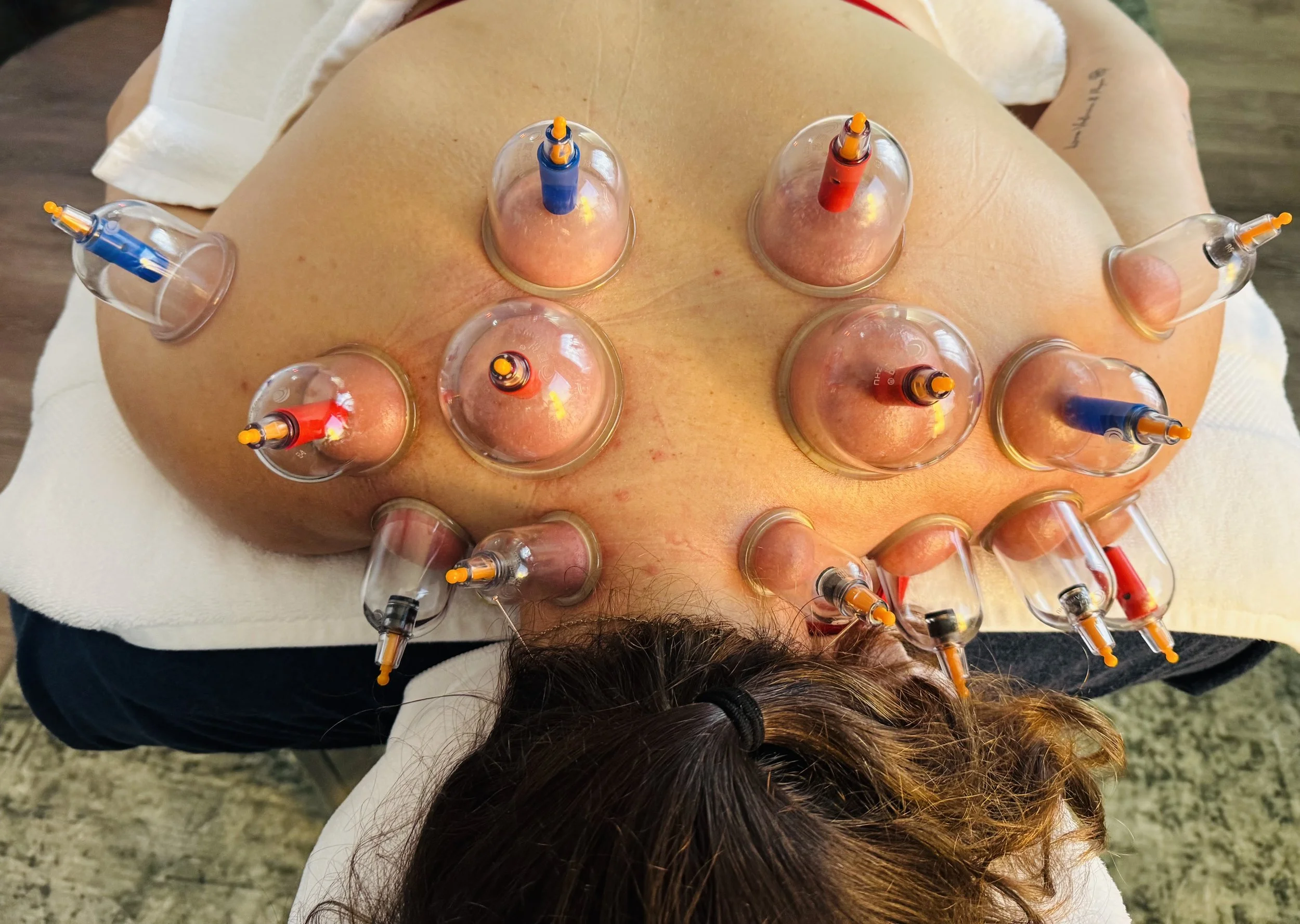 Willow Tree Acupuncture cupping