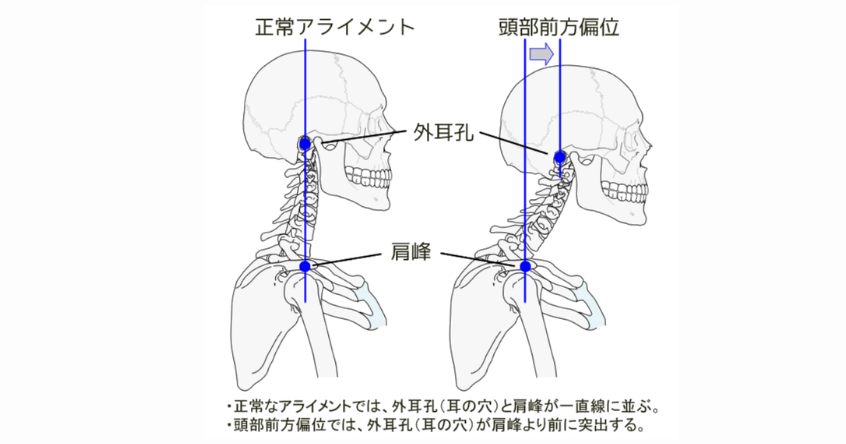正常姿勢と頭部前方変位（FHP）の違いを示したイラスト