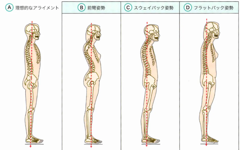 姿勢タイプを確認するためのアライメントセルフチェック図
