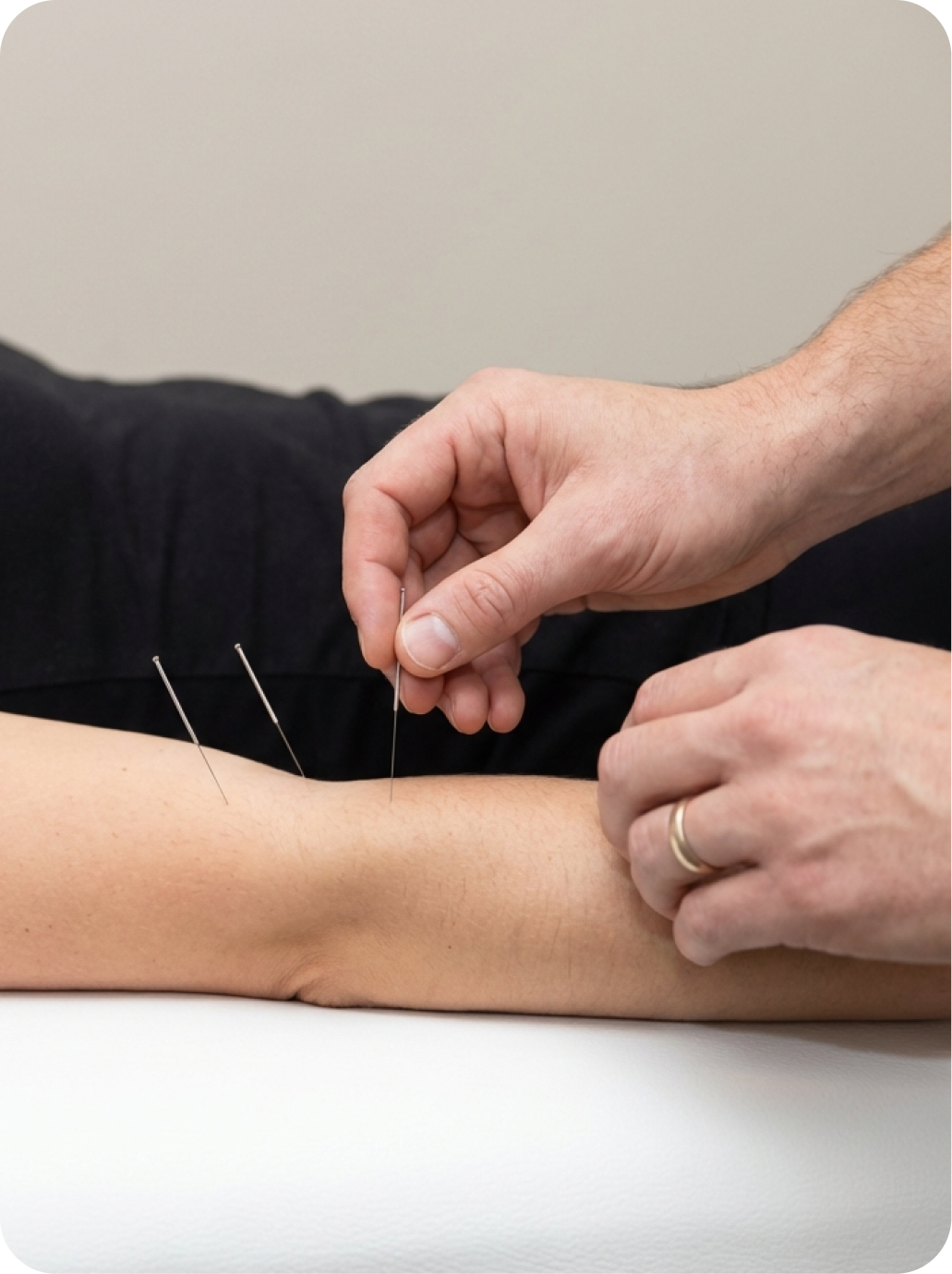 Person receiving dry needling treatment with multiple thin needles inserted into their forearm.