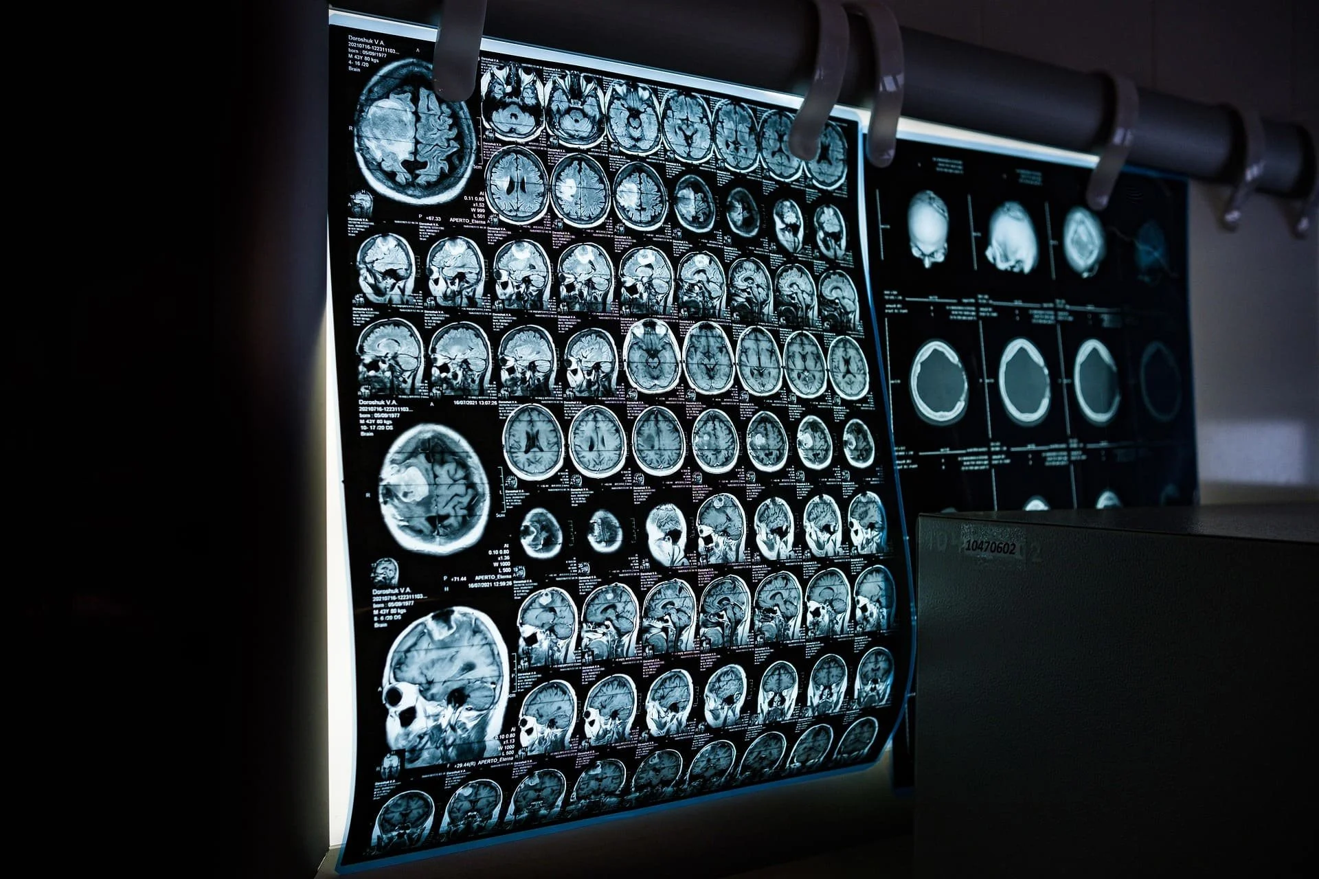 An illuminated display of multiple brain MRI scans on a lightbox in a medical setting.
