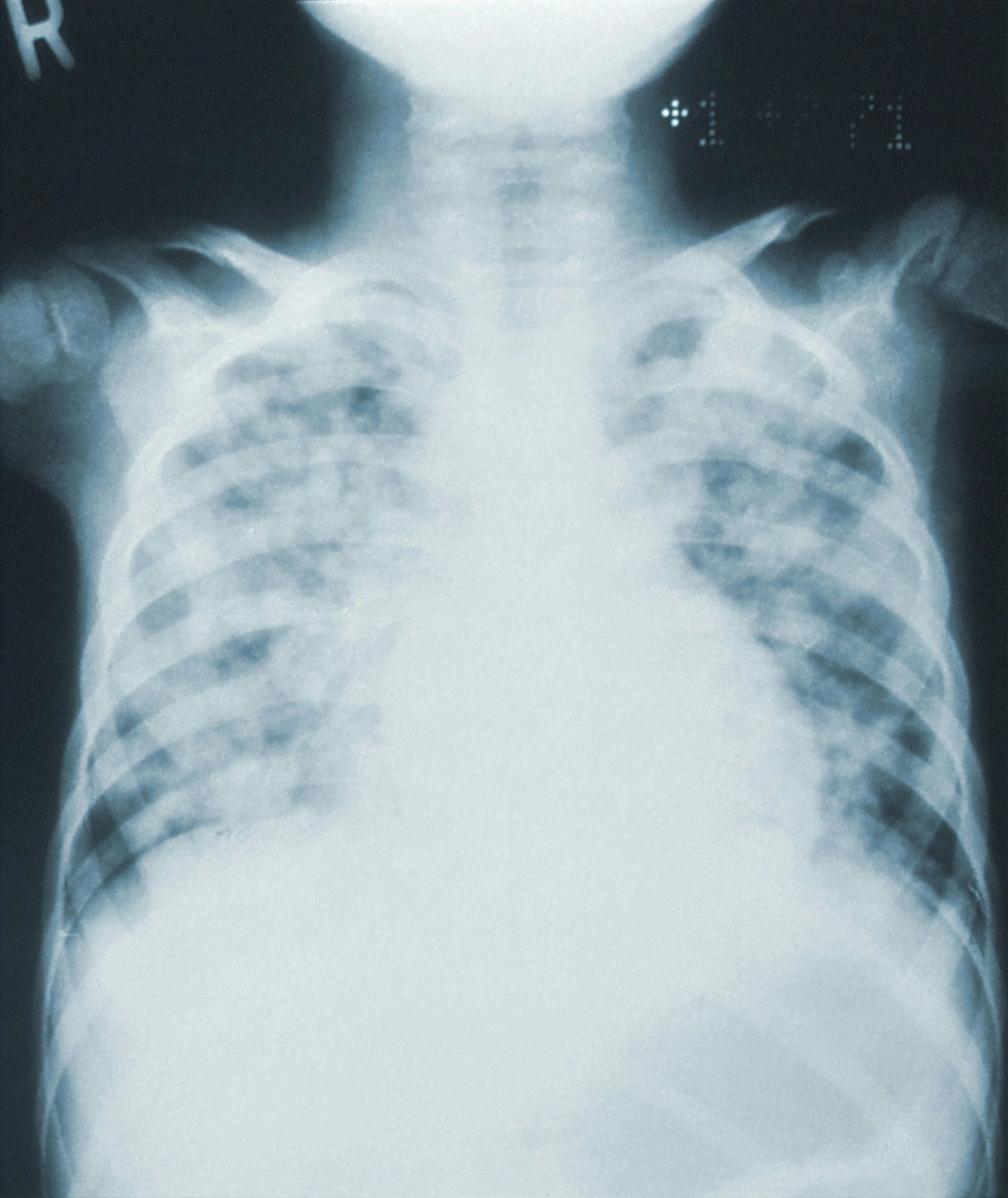 X-ray image of a person's chest showing ribs and lungs with a clear area in the center.