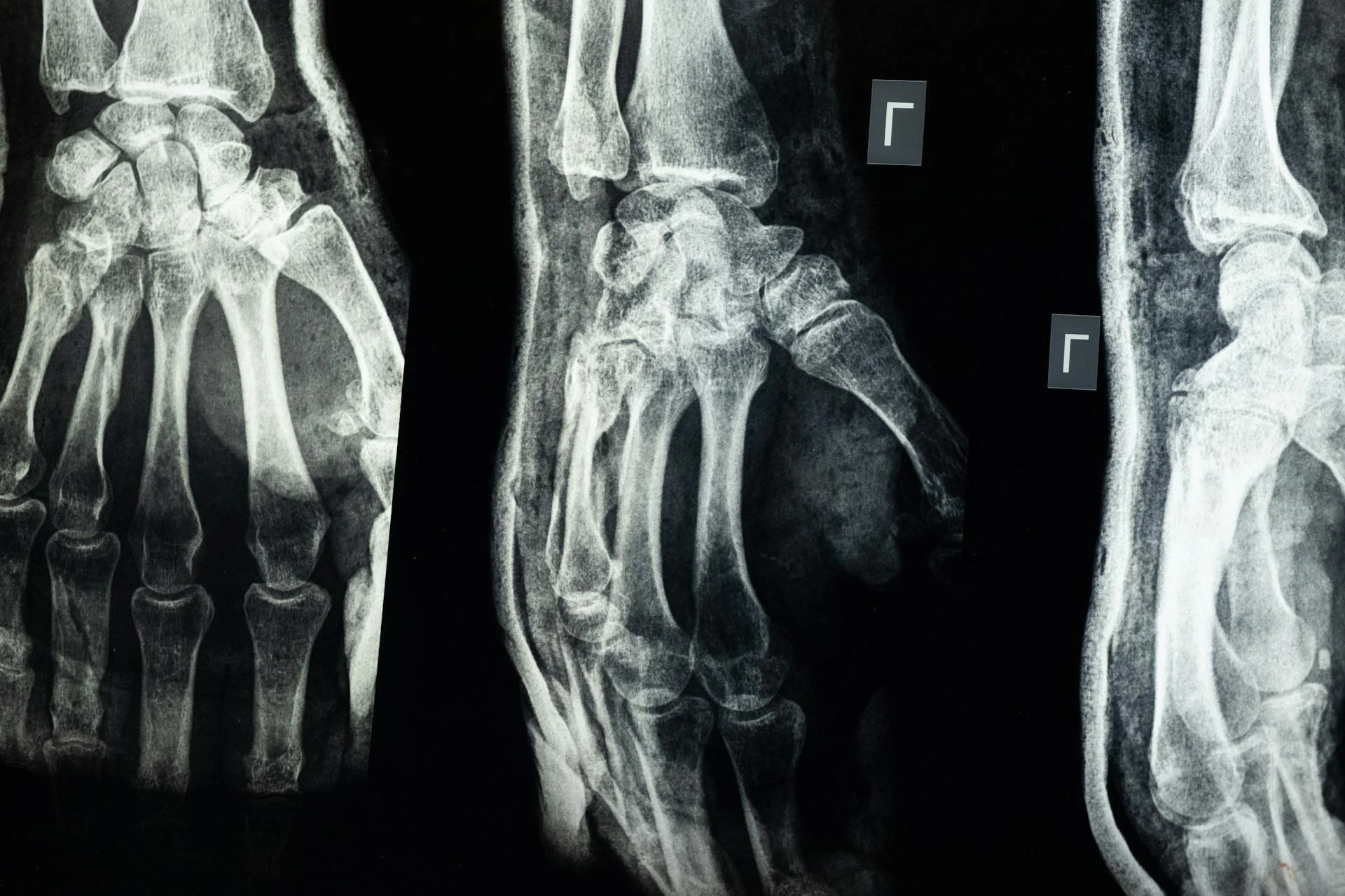 X-ray images of human feet and ankles, showing bone structures in black and white.