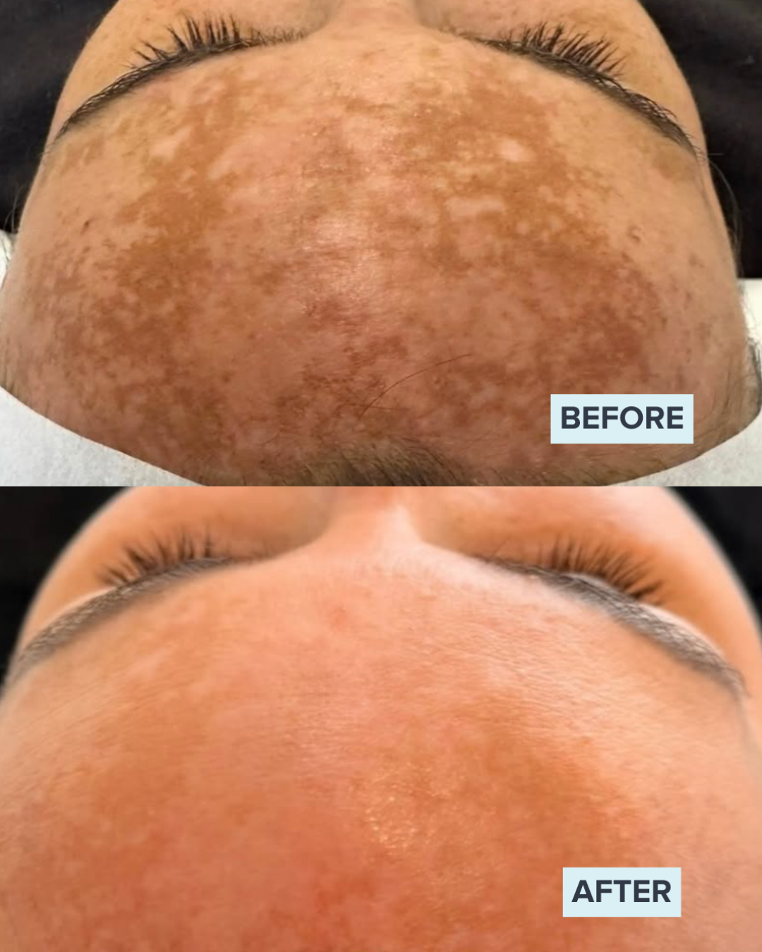 Pigmentation before and after Alumier TXA peel