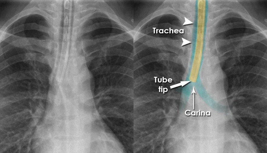 et_tube_711_450.jpg
