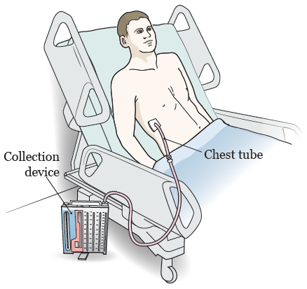 chest_tube_placement_procedure-fig_1-en.webp