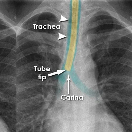 5/7: Chest tube and next steps in cancer