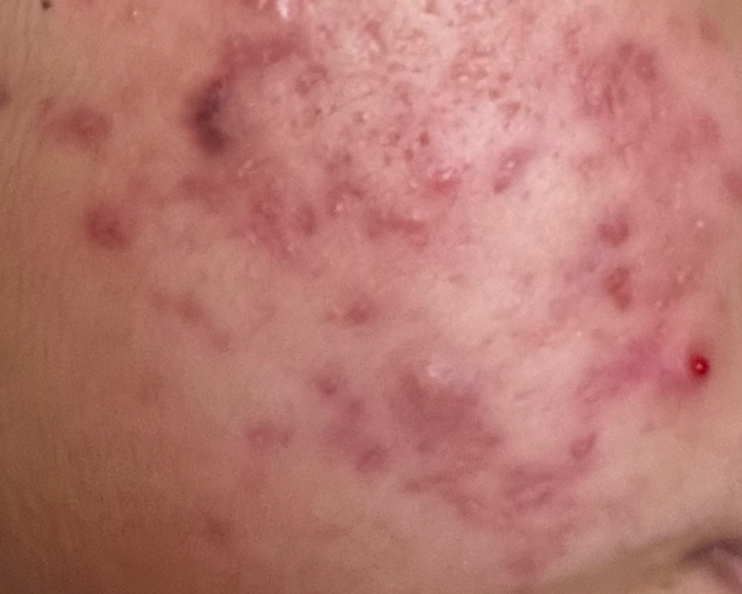 acne+pic+before+Large.png