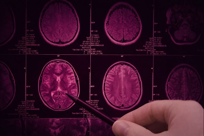 Medical professional analyzing brain MRI scans displayed on a lightbox with a pointer.