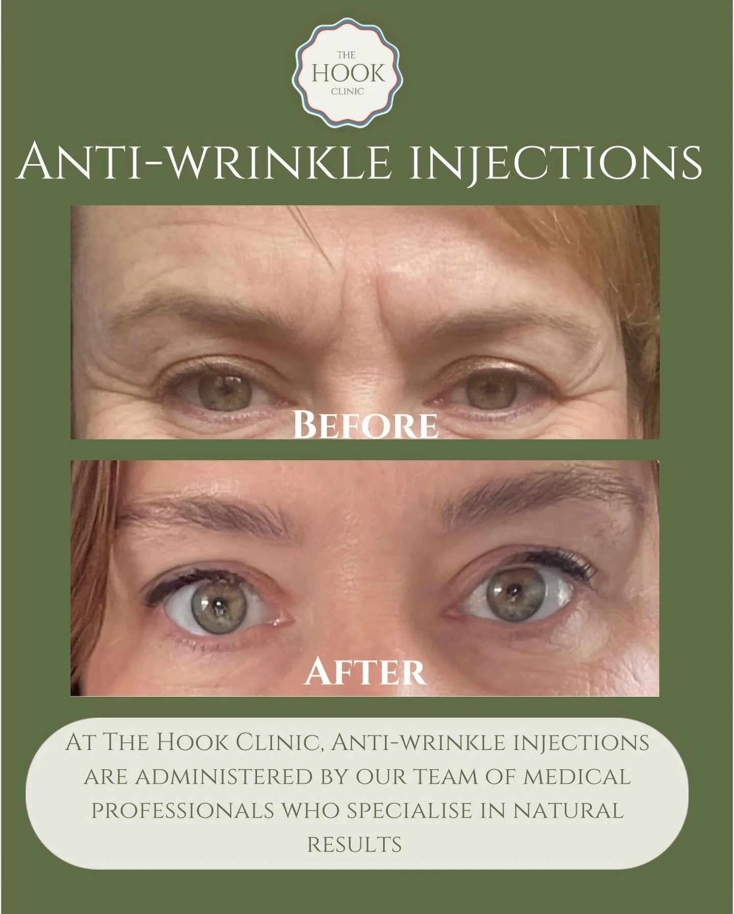 You deserve to feel confident in your skin. At The Hook Clinic in Skibbereen, our anti-wrinkle treatments are medically led, expertly delivered, and tailored to you. 
We specialise in soft, natural results that help you look refreshed and well-rested
