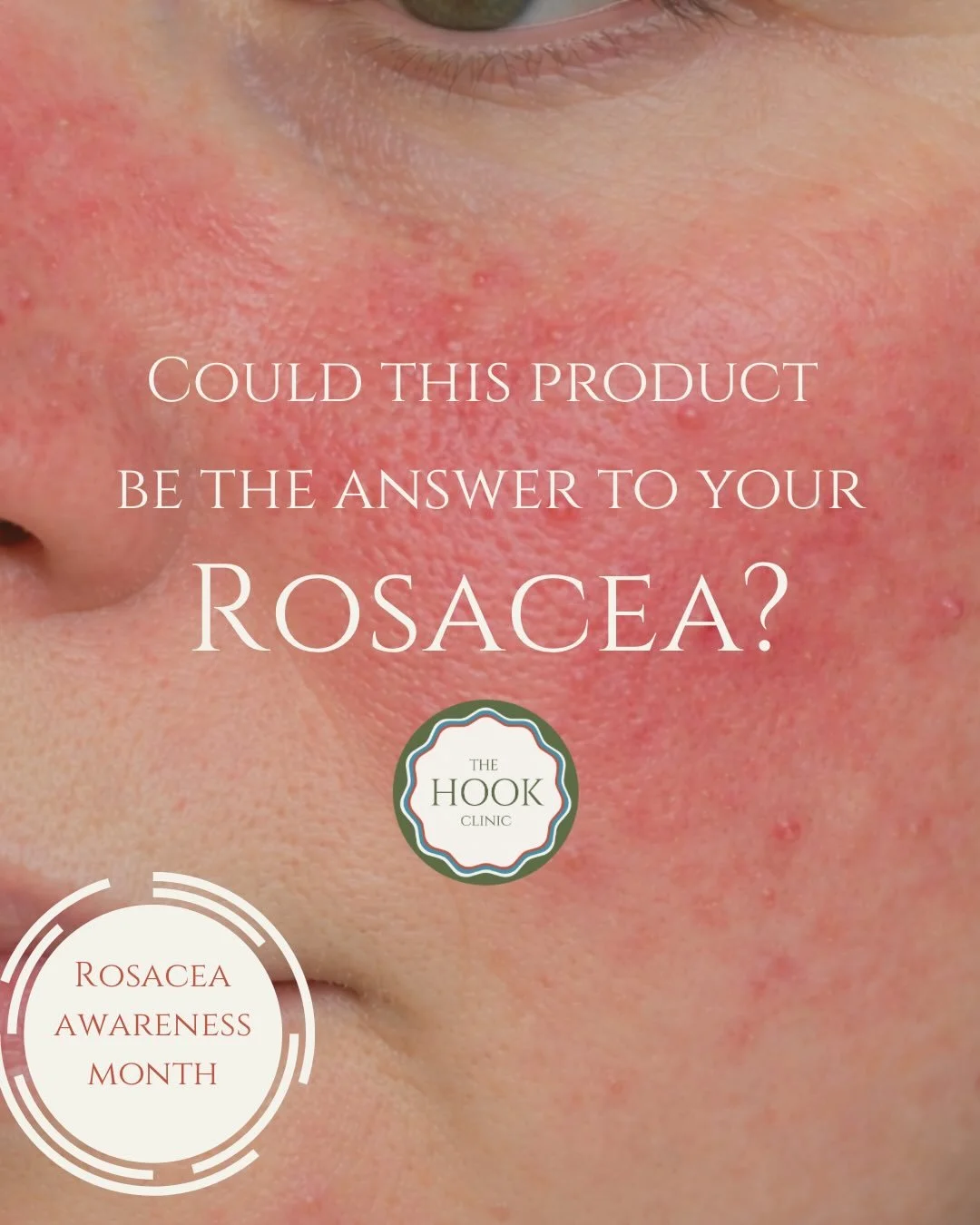 Rosacea isn&rsquo;t one-size-fits-all .

It can show up as flushing, persistent redness, visible blood vessels, dryness, sensitivity  and for some, breakouts or pustules too. It&rsquo;s a really varied skin condition, which is why what works for one 
