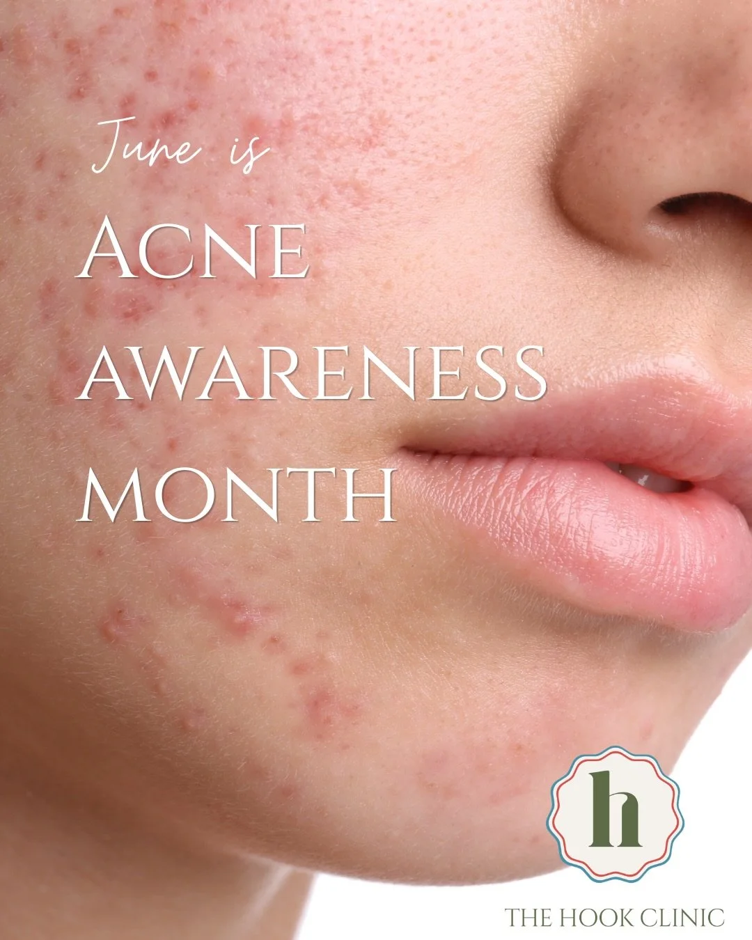 If acne or acne scarring is affecting your confidence, we are ready to support and guide you through the options available and find the right treatment plan.

June is Acne Awareness Month , share this post as a reminder to those in your life  that ac