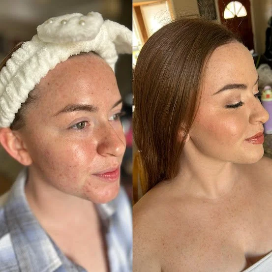 Side-by-side comparison of a woman before and after skincare treatment; first image shows her with acne and redness, wearing a white headband with a towel; second image shows her with clear, smooth skin and makeup, with long brown hair.